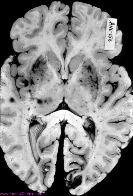 Bilateral hemorrhagic infarcts, lenticulostriate and thalamoperforant  circulations